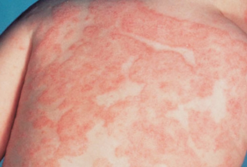 FDA phê duyệt idvynso điều trị HIV, mở thêm lựa chọn cho bệnh nhân đã ổn định virus- Ảnh 2.