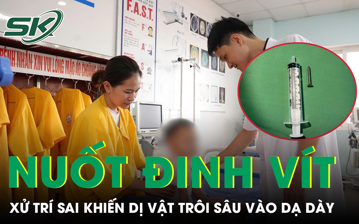 Bé 21 tháng tuổi nuốt đinh vít, người nhà xử trí sai cách khiến dị vật trôi sâu vào dạ dày