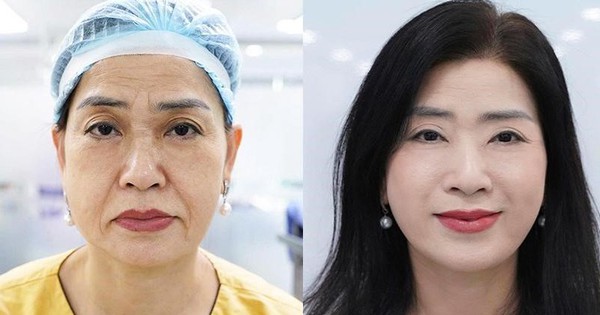 Căng da mặt – khi trẻ hóa không còn là ‘kéo da’ đơn thuần