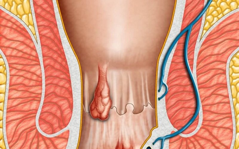 6 thói quen dễ gây bệnh trĩ mà nhiều người mắc phải