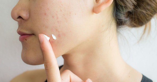 6 sai lầm khi chữa mụn trứng cá
