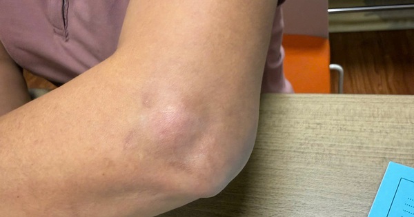 Cảnh báo mạo danh bác sĩ Bạch Mai tiêm thuốc khiến người bệnh gặp biến chứng