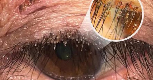 Phát hiện ổ rận mu bám dày trên mí mắt người phụ nữ
