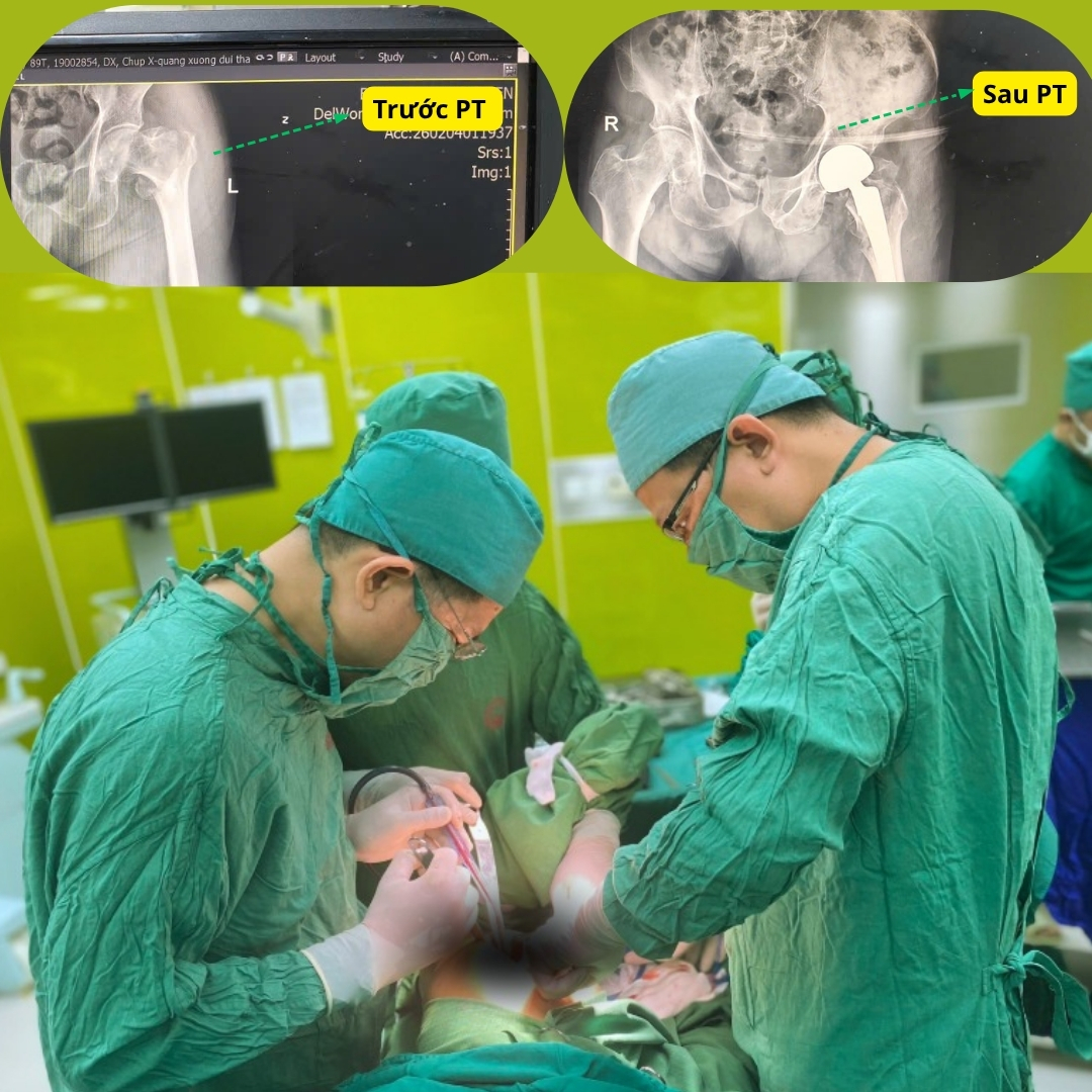 Thay khớp háng bán phần, cụ ông thoát đau và phục hồi nhanh- Ảnh 1.