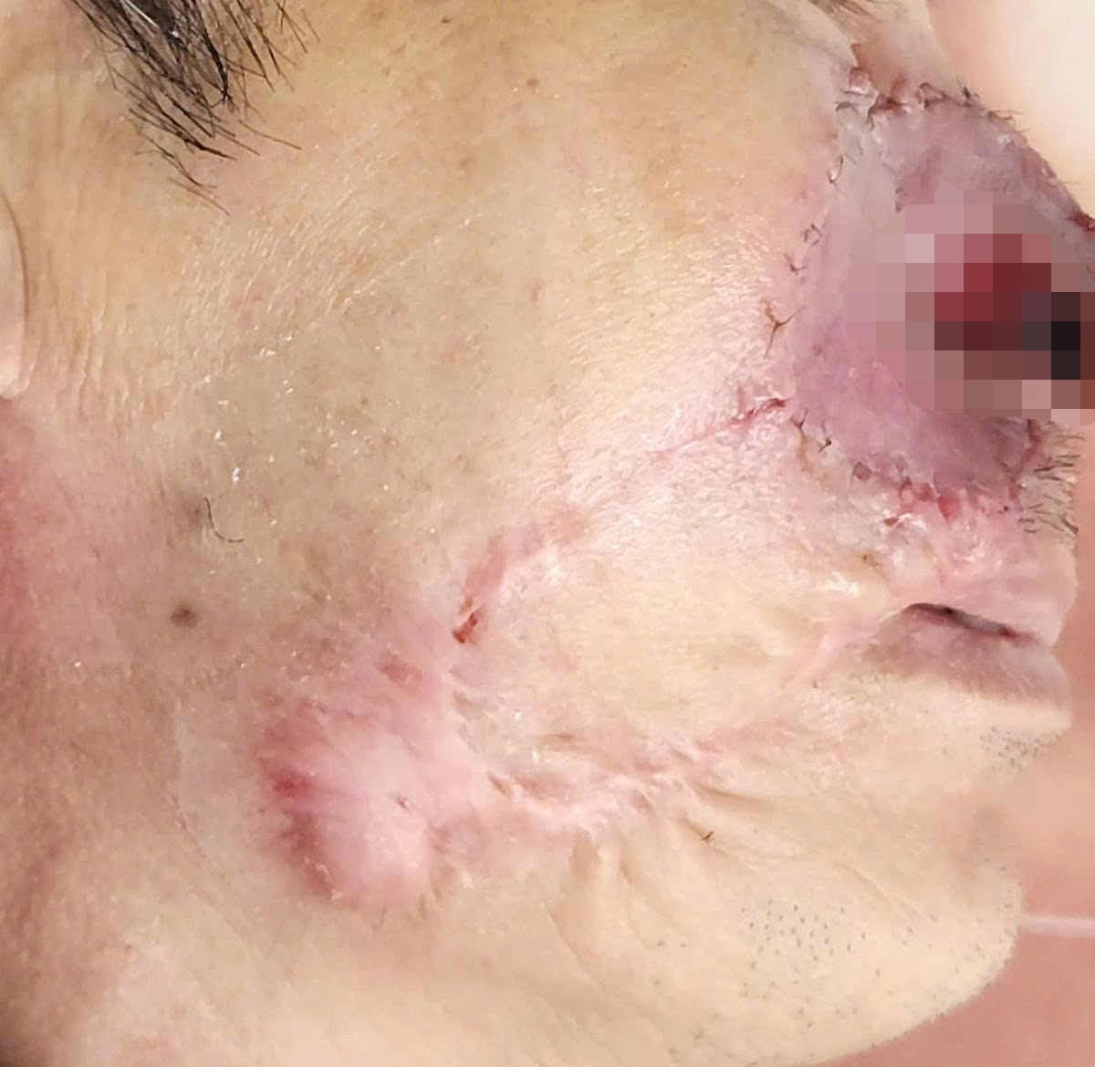 Vì sao 'mổ đi mổ lại' vẫn không hết ung thư da?- Ảnh 2.