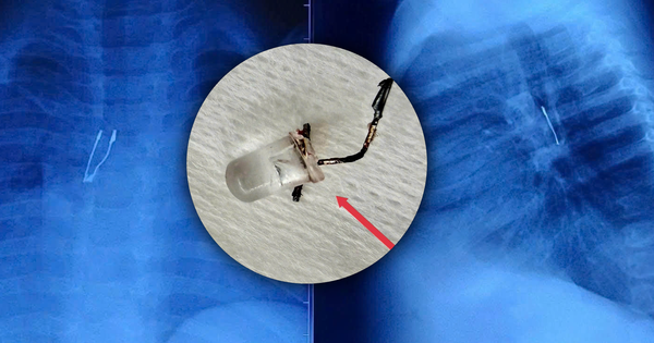 Bé 9 tháng tuổi sặc bóng đèn LED, nhập viện nguy kịch