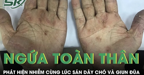 Ngứa toàn thân suốt 2 tháng, người đàn ông phát hiện nhiễm cùng lúc sán dây chó và giun đũa