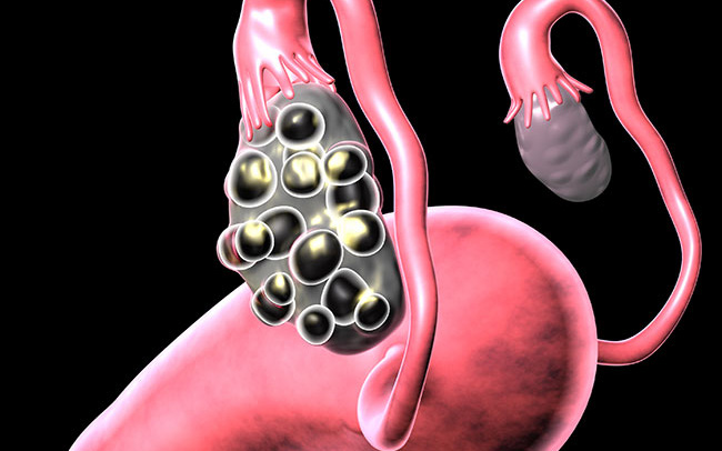Hội chứng buồng trứng đa nang: Triệu chứng, nguyên nhân và cách điều trị