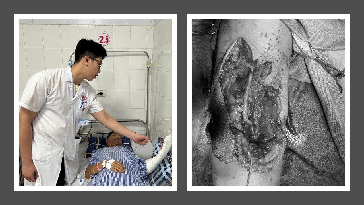 Phối hợp liên viện, cứu sống bệnh nhân đứt động mạch cánh tay- Ảnh 2.