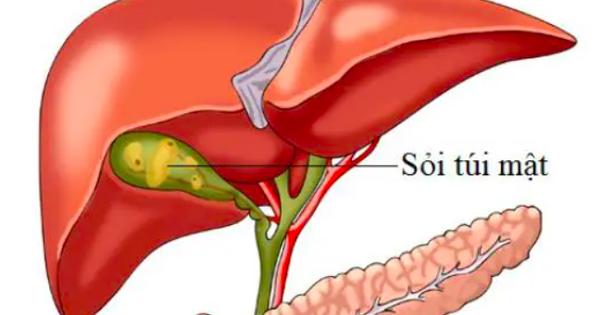 Dấu hiệu cảnh báo sỏi túi mật, nhận biết sớm để tránh biến chứng nguy hiểm