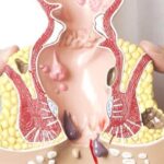 Bệnh trĩ ngoại có gây biến chứng không?