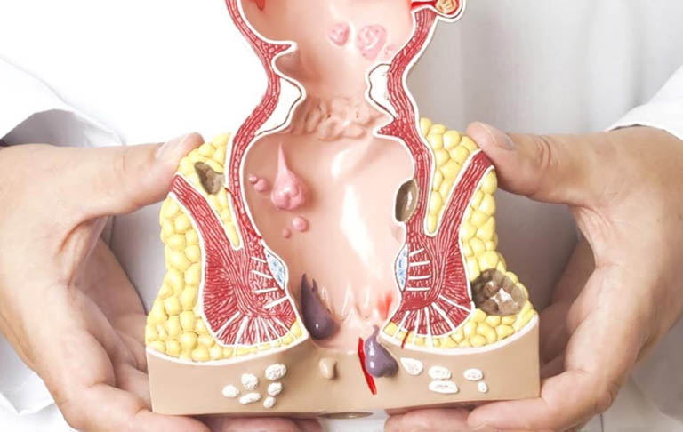 Bệnh trĩ ngoại có gây biến chứng không?- Ảnh 2.