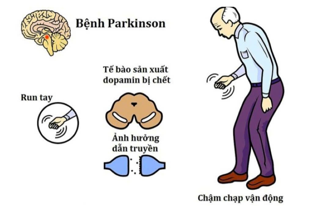 Uống cà phê có tốt cho người mắc bệnh Parkinson không?