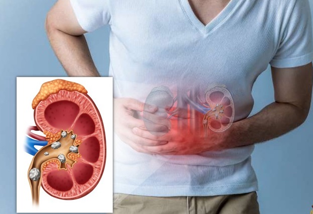 Sỏi thận có thể tự đào thải trong bao lâu, khi nào cần can thiệp?- Ảnh 1.