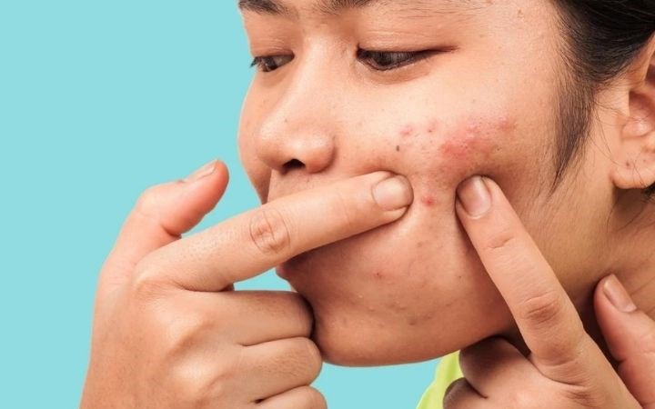 6 thói quen xấu gây mụn trứng cá