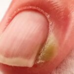 Chín mé ngón tay xử trí ra sao?