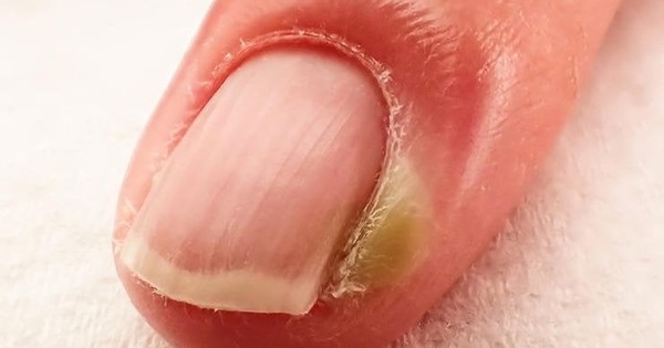 Chín mé ngón tay xử trí ra sao?