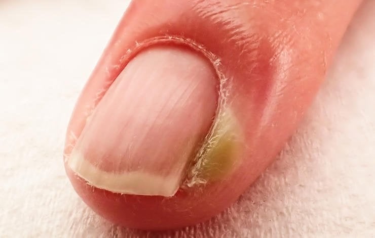 Chín mé ngón tay xử trí ra sao?- Ảnh 2.