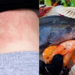 Cách phòng ngừa dị ứng hải sản khi đi biển dịp nghỉ lễ 30/4