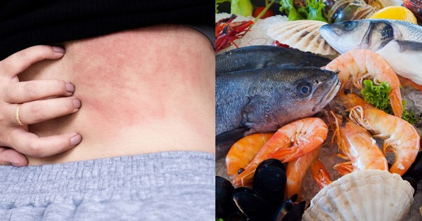 Cách phòng ngừa dị ứng hải sản khi đi biển dịp nghỉ lễ 30/4