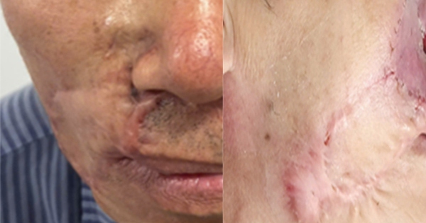 Vì sao ‘mổ đi mổ lại’ vẫn không hết ung thư da?