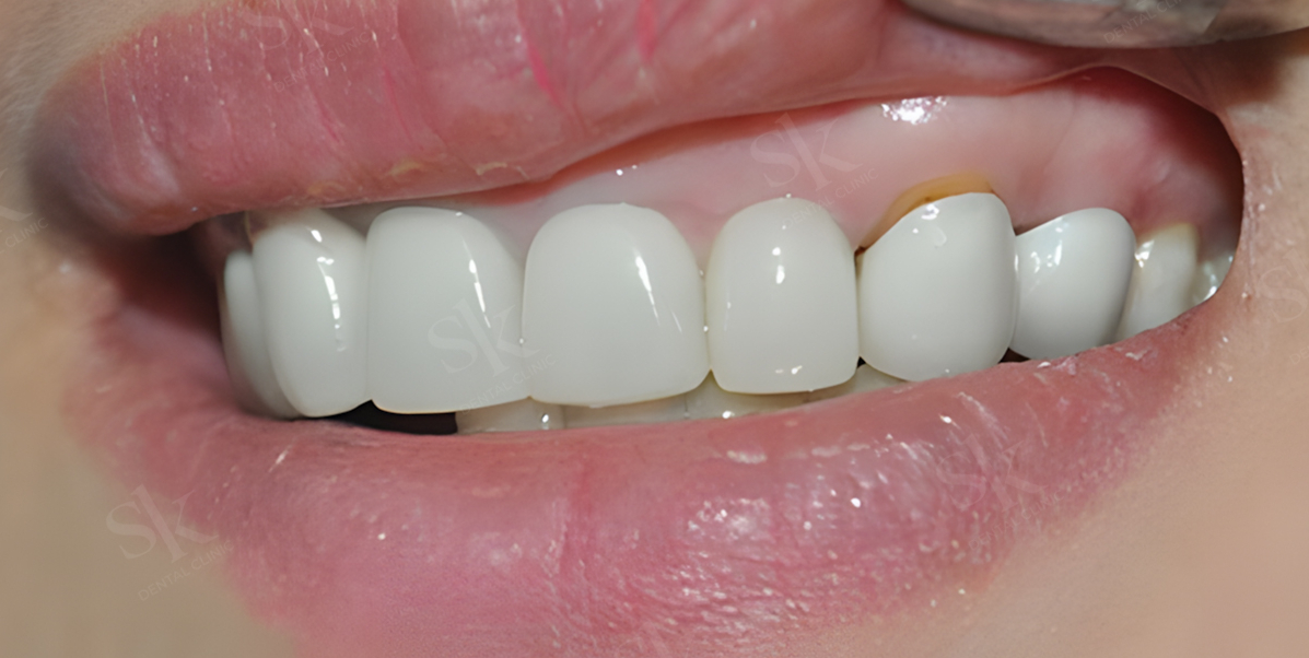 Viêm nướu sau bọc răng sứ chủ yếu do kỹ thuật và chăm sóc không đúng cách.