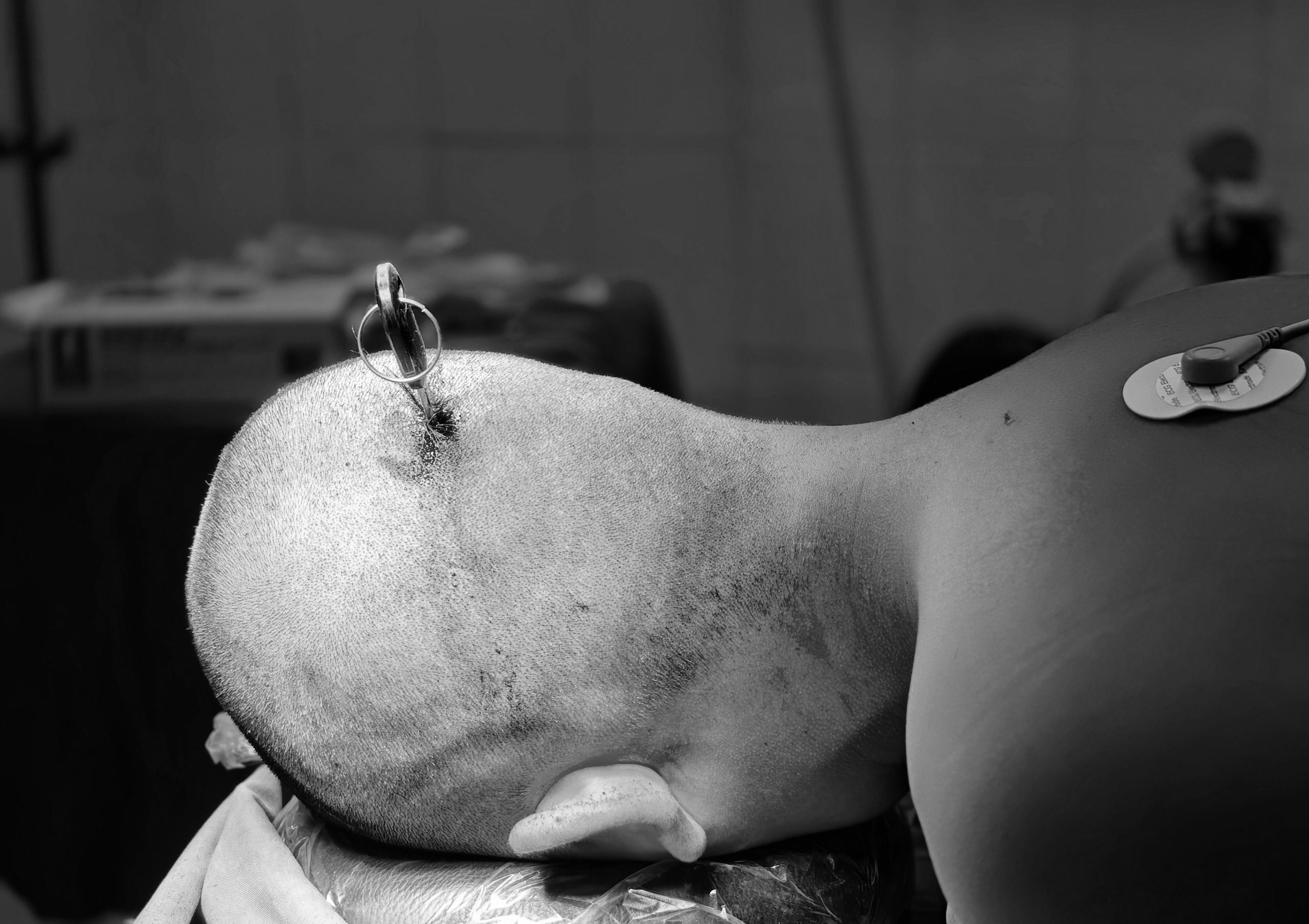 Thiếu niên 14 tuổi nhập viện cấp cứu với chiếc chìa khoá... cắm vào đầu- Ảnh 1.