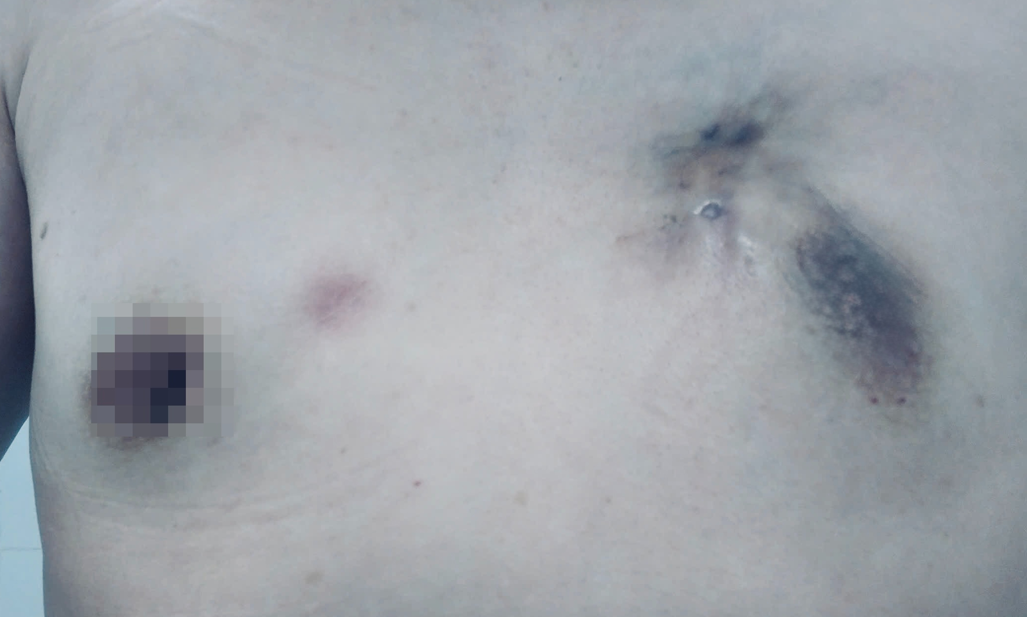 Cá thể hóa điều trị, 'chìa khóa' để bệnh nhân ung thư vú giai đoạn IV đáp ứng tốt- Ảnh 2.