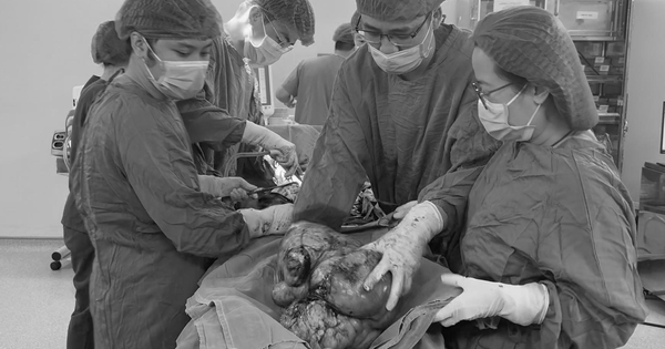 Người phụ nữ chịu đau âm ỉ vùng bụng suốt 6 tháng, đến viện, bác sĩ ‘lấy ra’ khối u sarcoma tử cung gần 9kg