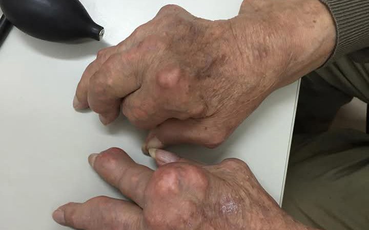 Gout mạn tính gây biến dạng khớp tay, chân xử trí ra sao?