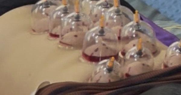 Chuyên gia lên tiếng về ‘giác hơi hút máu’ ở Hà Nội: Sai chuyên môn, đe dọa sức khoẻ, tính mạng