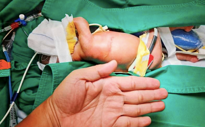 Tật lỗ tiểu đóng thấp ảnh hưởng như thế nào?- Ảnh 2.