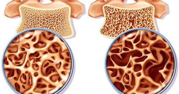 4 bí quyết giúp người lớn tuổi giảm nguy cơ loãng xương