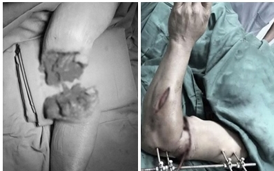 Người đàn ông bị lưỡi máy cắt cỏ văng trúng đứt lìa bàn chân- Ảnh 2.