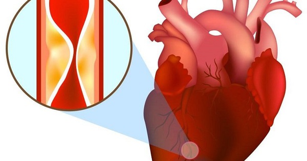 Bỗng dưng bị đau thắt ngực, cảnh giác với nhồi máu cơ tim