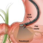 Siêu âm nội soi đường tiêu hóa trên cần lưu ý gì?