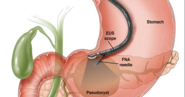 Siêu âm nội soi đường tiêu hóa trên cần lưu ý gì?