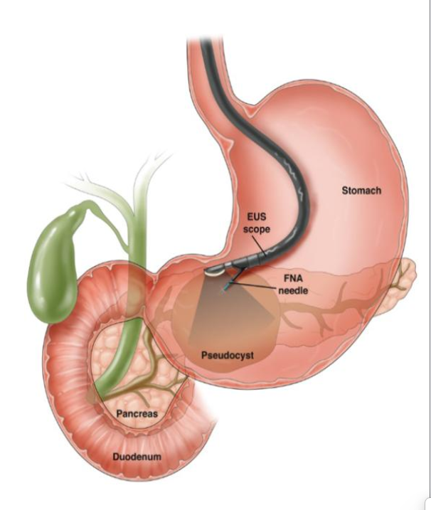 Siêu âm nội soi đường tiêu hóa trên cần lưu ý gì?- Ảnh 1.