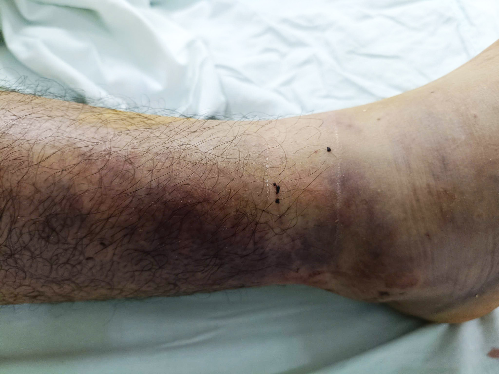 Liên tiếp ca nhập viện nguy kịch do rắn cắn, cách xử trí đúng tránh biến chứng- Ảnh 1.