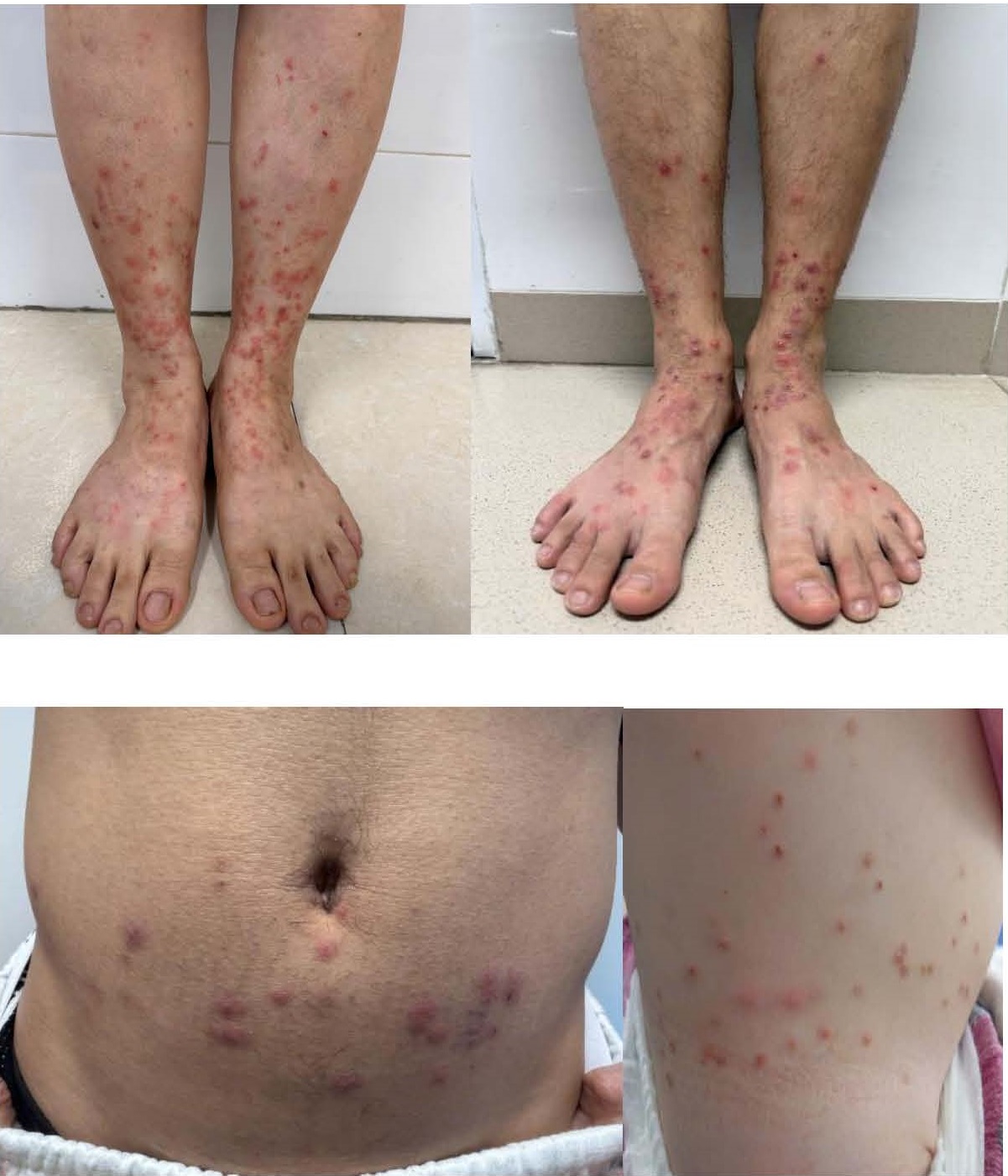 Viêm da do bọ chét: Dấu hiệu nhận biết sớm và cách xử lý tránh nhiễm trùng- Ảnh 2.