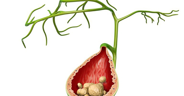 Vì sao sỏi mật hay tái phát và cách phòng ngừa hiệu quả