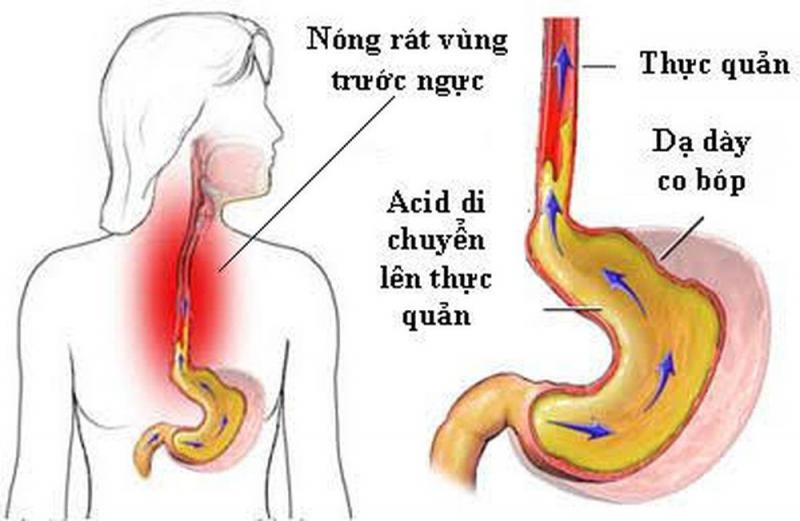 Bị trào ngược dạ dày có nên uống nghệ mật ong?- Ảnh 1.
