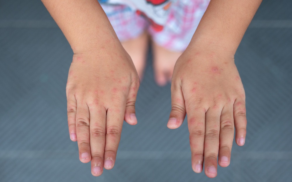 Các cấp độ bệnh tay chân miệng và dấu hiệu cảnh báo