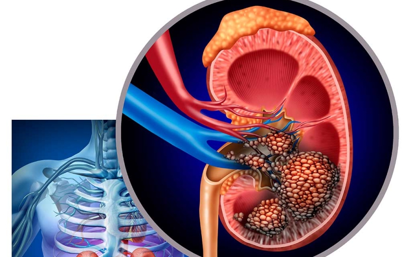 Đau vùng hông lưng, người phụ nữ phát hiện khối u thận