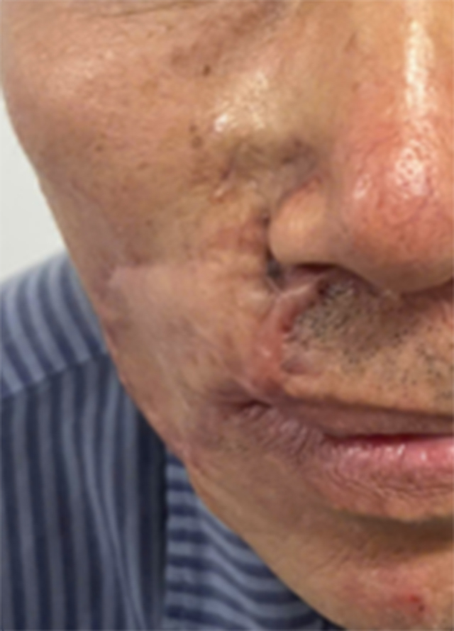 Vì sao 'mổ đi mổ lại' vẫn không hết ung thư da?- Ảnh 1.