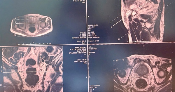 Sinh thiết đích qua tầng sinh môn, bệnh nhân ung thư tiền liệt tuyến được can thiệp kịp thời, điều trị ổn định