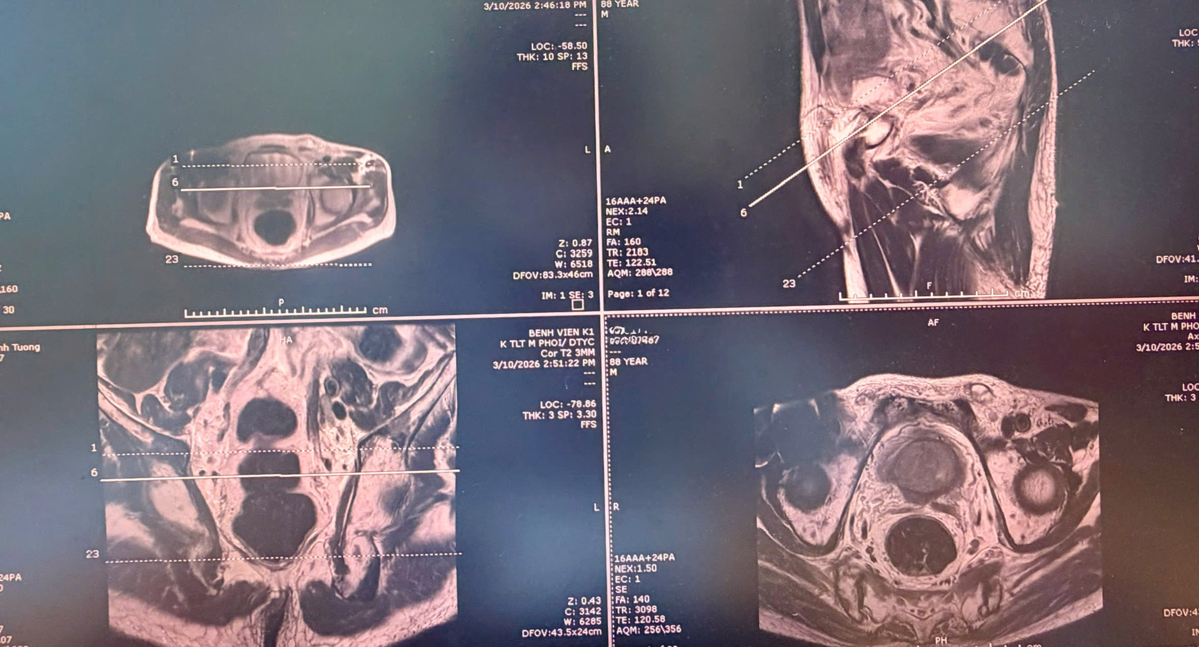 Sinh thiết đích qua tầng sinh môn, bệnh nhân ung thư tiền liệt tuyến được can thiệp kịp thời, điều trị ổn định- Ảnh 1.