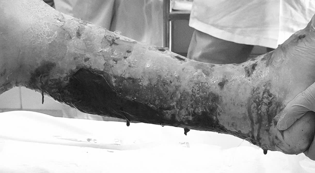 Suýt mất mạng vì tự bôi dầu gió, chườm đá vào vết thương- Ảnh 2.