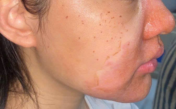 Peel da mặt làm đẹp, cô gái mọc chi chít mụn nước, vỡ chảy dịch- Ảnh 1. Peel da mặt làm đẹp, cô gái mọc chi chít mụn nước, vỡ chảy dịch- Ảnh 1.