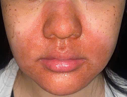 Peel da mặt làm đẹp, cô gái mọc chi chít mụn nước, vỡ chảy dịch- Ảnh 2. Peel da mặt làm đẹp, cô gái mọc chi chít mụn nước, vỡ chảy dịch- Ảnh 2.